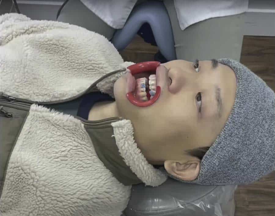 invisalign placement